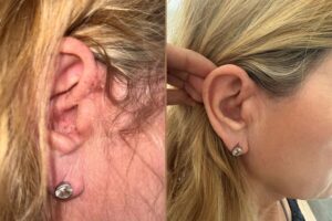 Schuppige-Haut-entfernen