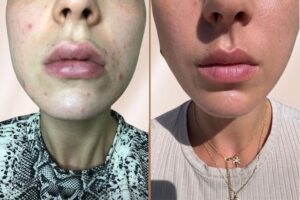 Unreine-haut-loswerden