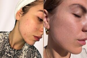 pickel-loswerden-gesicht